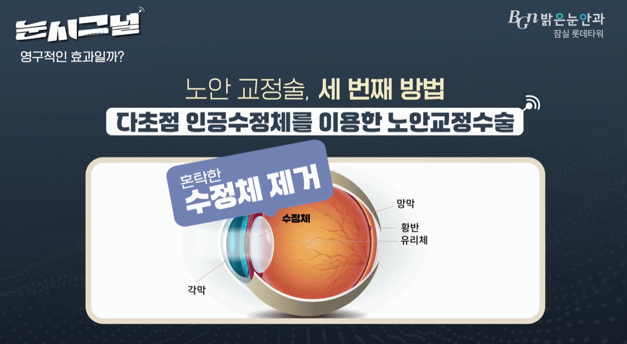 백내장 치료 과정 설명